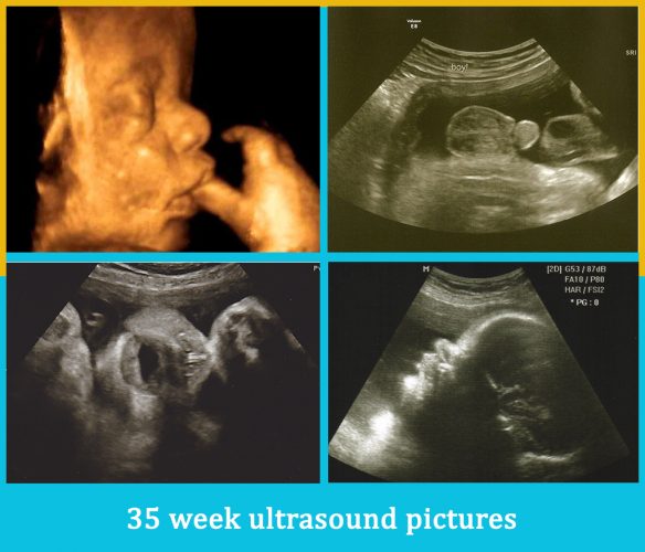 35 week ultrasound pictures