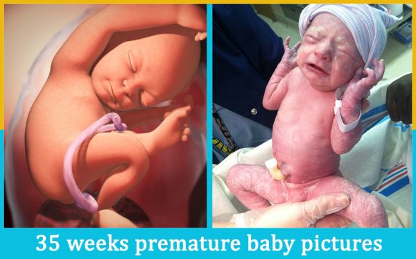 35 weeks premature baby pictures