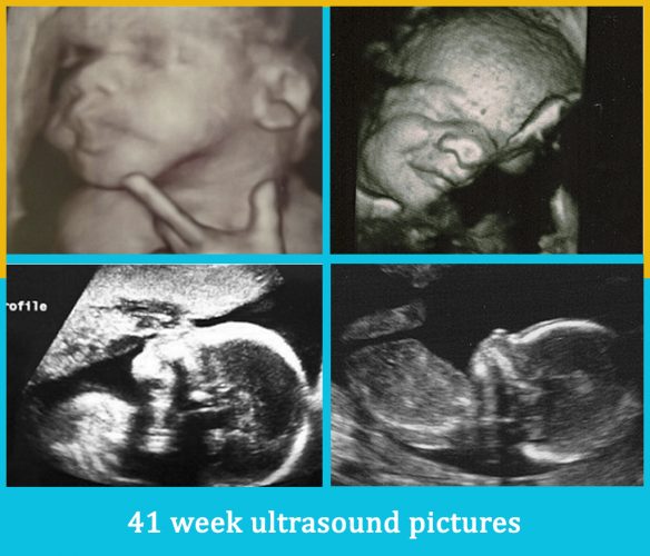 41 week ultrasound pictures