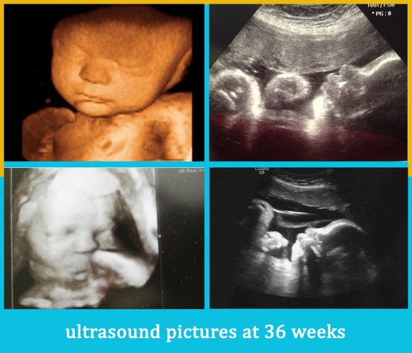 ultrasound pictures at 36 weeks